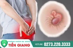 Bị lòi trĩ ra ngoài phải làm sao? Cách điều trị bệnh trĩ hiệu quả