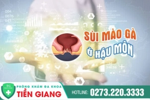 Những Điều Bạn Cần Biết Về Sùi Mào Gà Hậu Môn