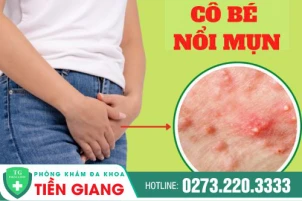 Cô Bé Nổi Mụn - Cách Điều Trị Hiệu Quả
