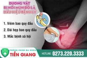 Nổi Mụn Ở Dương Vật Có Phải Dấu Hiệu Của Bệnh Xã Hội?