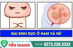 DẤU HIỆU NHẬN BIẾT GAI SINH DỤC Ở NAM VÀ NỮ