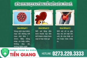 Sùi Mào Gà Phát Triển Như Thế Nào Qua Từng Giai Đoạn?