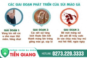 Cùng Giới Chuyên Gia Tìm Hiểu Tổng Quan Về Bệnh Sùi Mào Gà