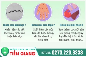 Bệnh giang mai ở nam giới: Triệu chứng, cách điều trị