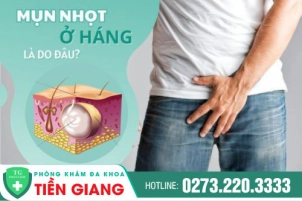 Mụn Nhọt Ở Háng: Dấu Hiệu Mắc Các Bệnh Xã Hội