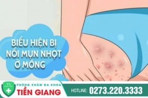 Trị mụn nhọt ở mông Tiền Giang – Mụn nhọt ở mông là bệnh gì?