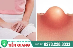 Nổi mụn nhọt vùng kín do đâu? Cách nào điều trị hiệu quả?