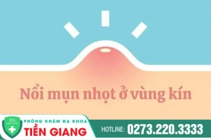 Biểu Hiện Nổi Nhọt Ở Vùng Kín Là Dấu Hiệu Của Bệnh Lý Gì? Nguyên Nhân Và Cách Khắc Phục