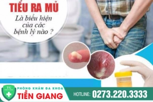 Tiểu ra mủ có phải mắc bệnh lậu không?