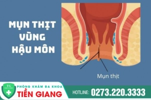 Cách trị nổi mụn ở hậu môn Tiền Giang - Nổi mụn ở hậu môn là bị bệnh gì?