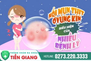 Điều trị mụn thịt Tiền Giang - Nổi mụn thịt ở vùng kín có nguy hiểm không?