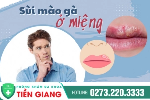 Biểu Hiện Và Mức Độ Nguy Hiểm Khi Bị Sùi Mào Gà Ở Miệng