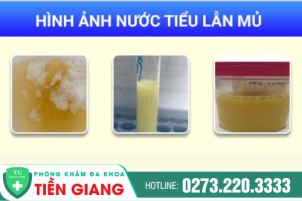 Tiểu Buốt Ra Mủ - Dấu Hiệu Cảnh Báo Mắc Bệnh Lý Nguy Hiểm