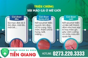 Các Phương Pháp Hỗ Trợ Nhận Biết Sùi Mào Gà Ở Nữ Giới