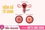 Triệu chứng cảnh báo bị viêm cổ tử cung